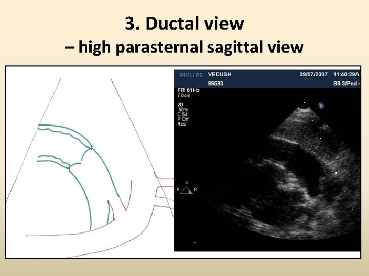 3. Ductal view – high parasternal sagittal view 