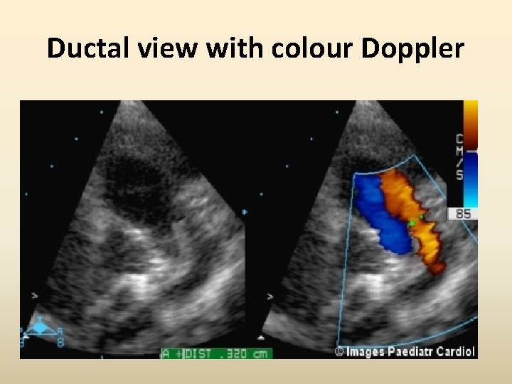 Ductal view with colour Doppler 
