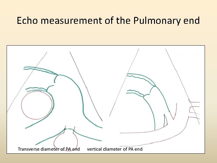 Echo measurement of the Pulmonary end 