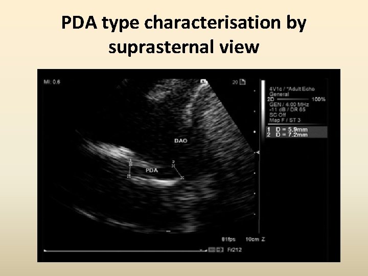 PDA type characterisation by suprasternal view 