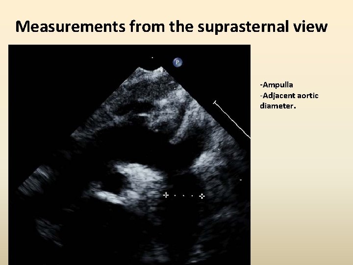 Measurements from the suprasternal view -Ampulla -Adjacent aortic diameter. 