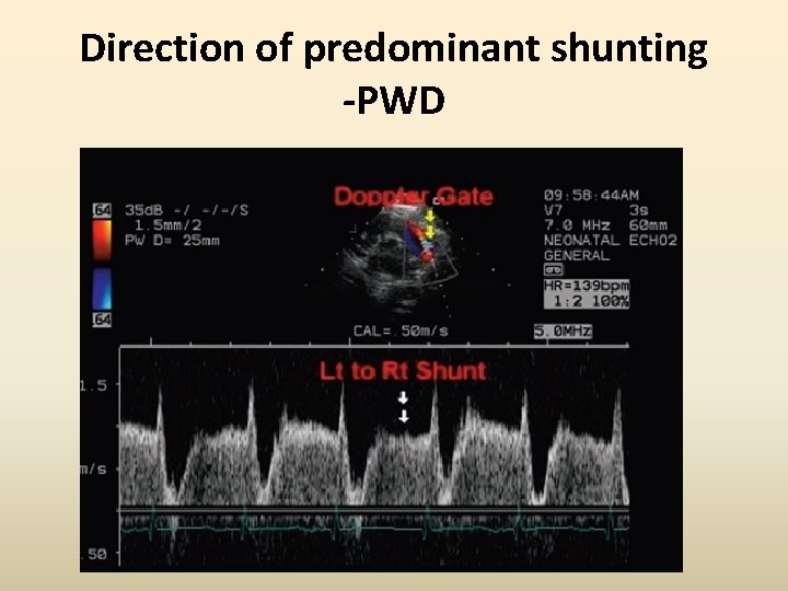 Direction of predominant shunting -PWD 