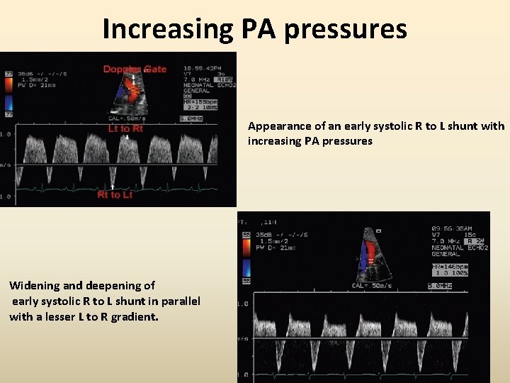 Increasing PA pressures Appearance of an early systolic R to L shunt with increasing