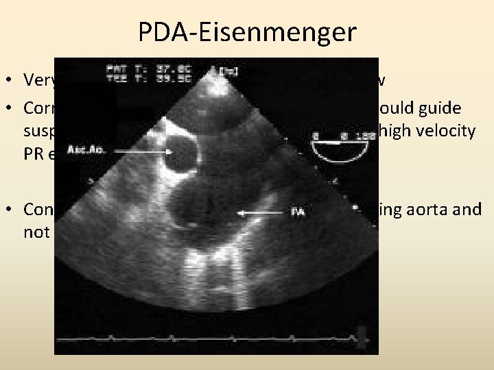 PDA-Eisenmenger • Very difficult to demonstrate the Doppler flow • Corroborative evidence and clinical