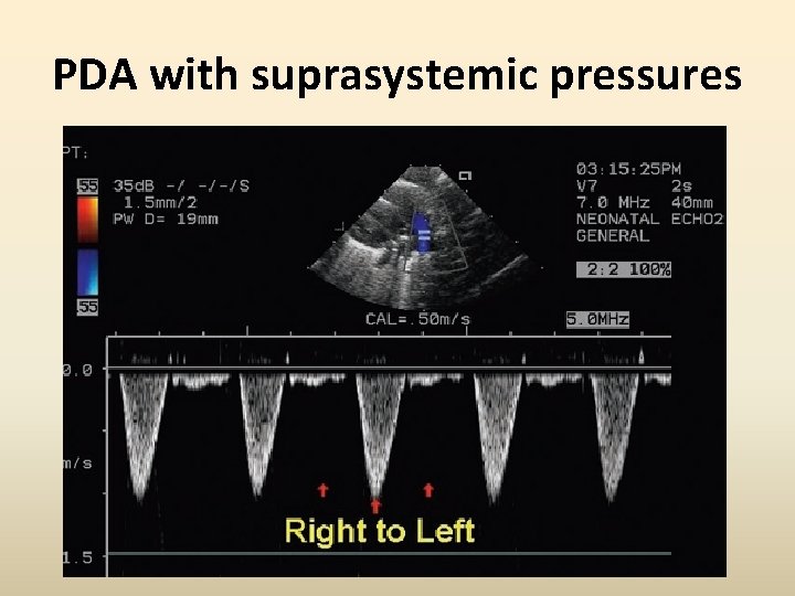 PDA with suprasystemic pressures 
