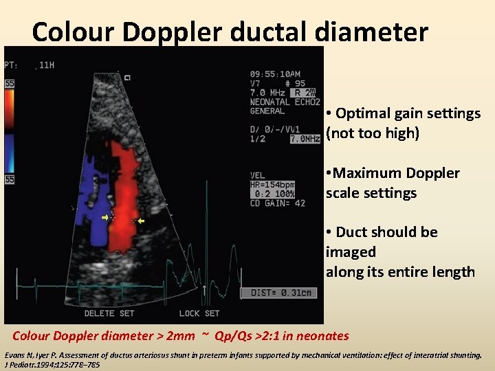 Colour Doppler ductal diameter • Optimal gain settings (not too high) • Maximum Doppler