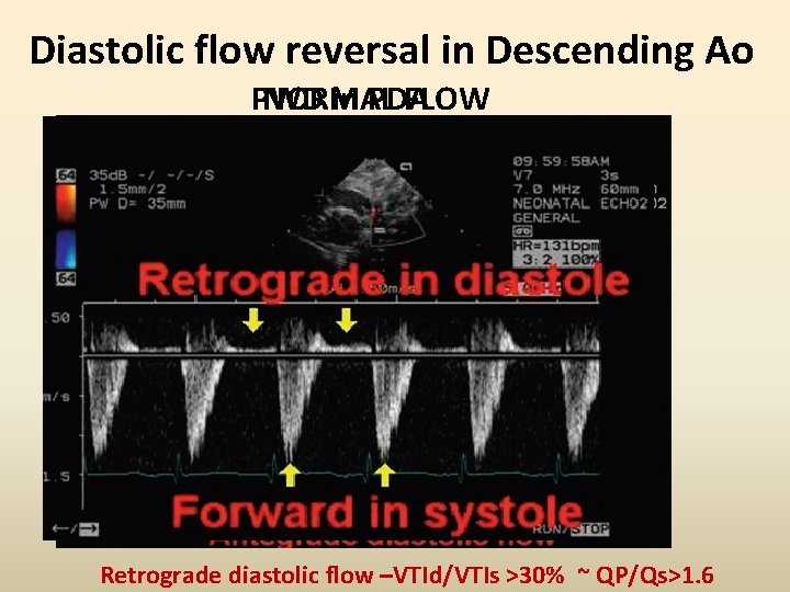 Diastolic flow reversal in Descending Ao PWD NORMAL in PDA FLOW Retrograde diastolic flow