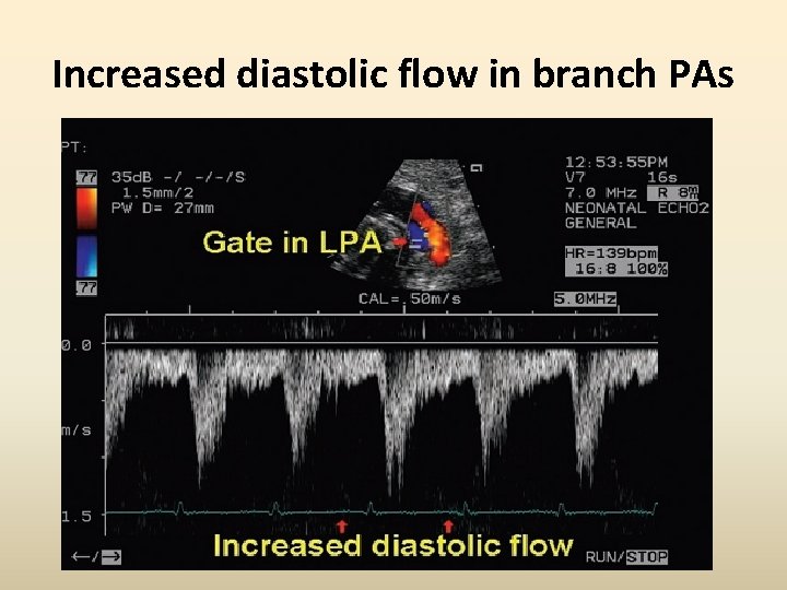 Increased diastolic flow in branch PAs 