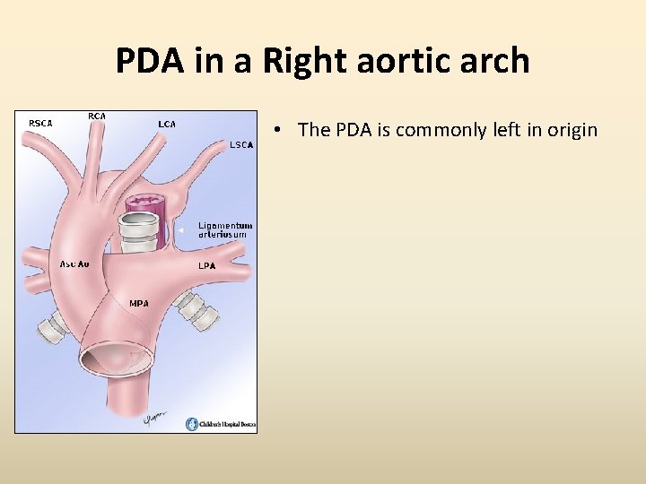 PDA in a Right aortic arch • The PDA is commonly left in origin