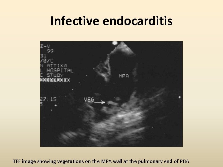 Infective endocarditis TEE image showing vegetations on the MPA wall at the pulmonary end