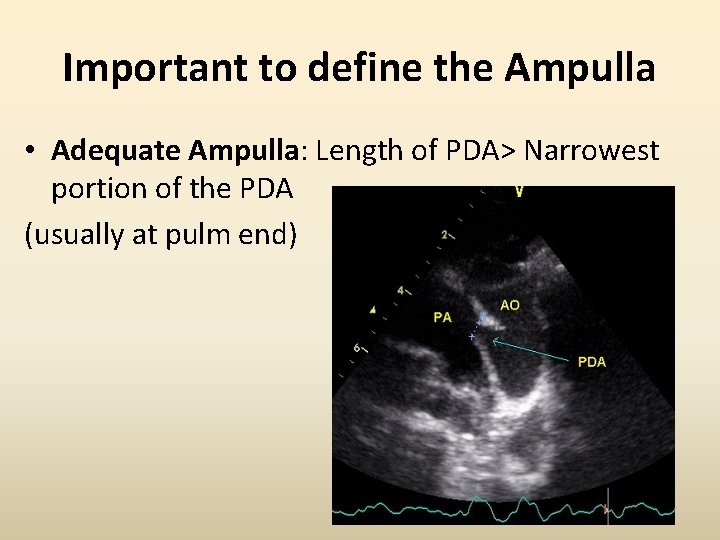 Important to define the Ampulla • Adequate Ampulla: Length of PDA> Narrowest portion of