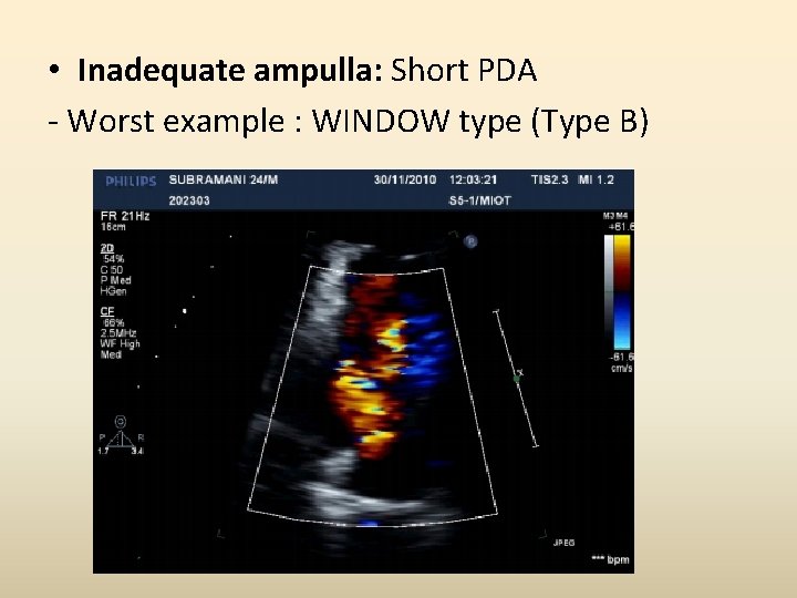  • Inadequate ampulla: Short PDA - Worst example : WINDOW type (Type B)