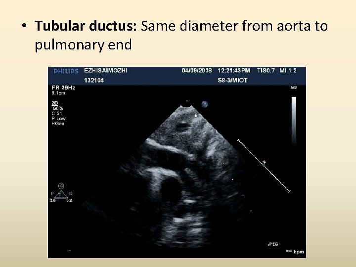  • Tubular ductus: Same diameter from aorta to pulmonary end 