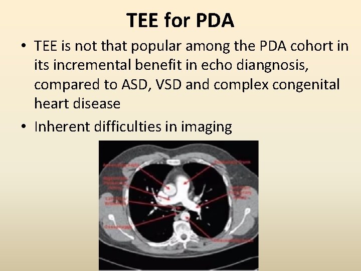 TEE for PDA • TEE is not that popular among the PDA cohort in