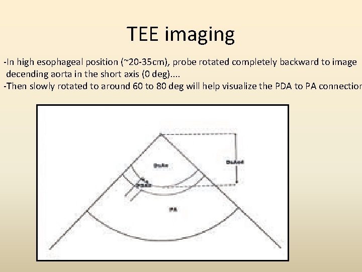 TEE imaging -In high esophageal position (~20 -35 cm), probe rotated completely backward to