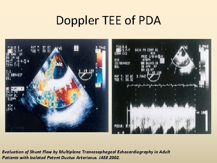 Doppler TEE of PDA Evaluation of Shunt Flow by Multiplane Transesophageal Echocardiography in Adult