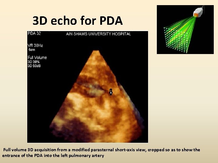 3 D echo for PDA Full volume 3 D acquisition from a modified parasternal