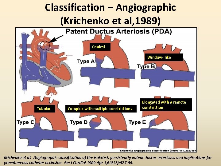 Classification – Angiographic (Krichenko et al, 1989) Conical Window- like Tubular Complex with multiple