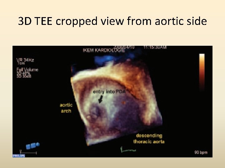 3 D TEE cropped view from aortic side 