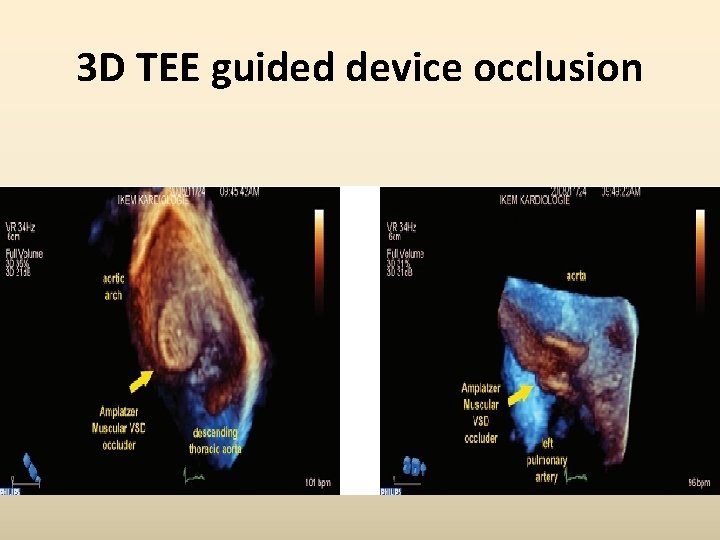 3 D TEE guided device occlusion 