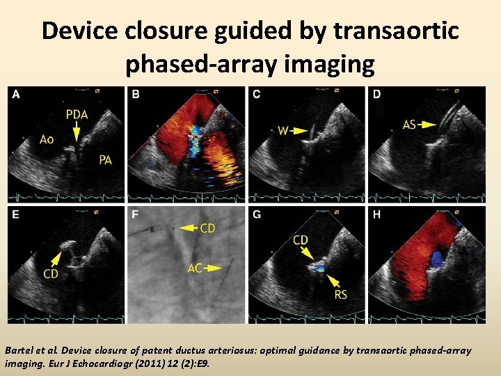 Device closure guided by transaortic phased-array imaging Bartel et al. Device closure of patent