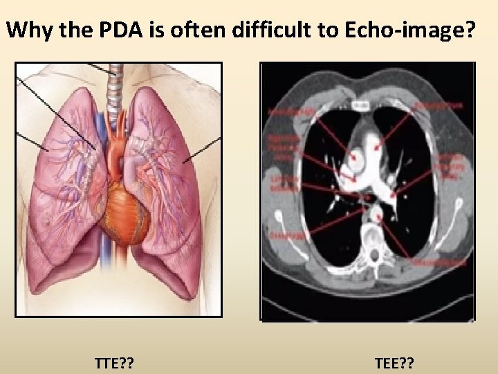 Why the PDA is often difficult to Echo-image? TTE? ? TEE? ? 