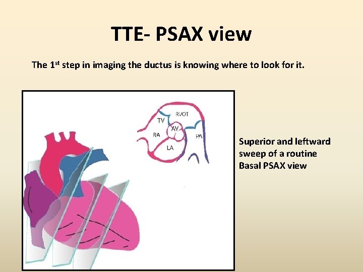 TTE- PSAX view The 1 st step in imaging the ductus is knowing where