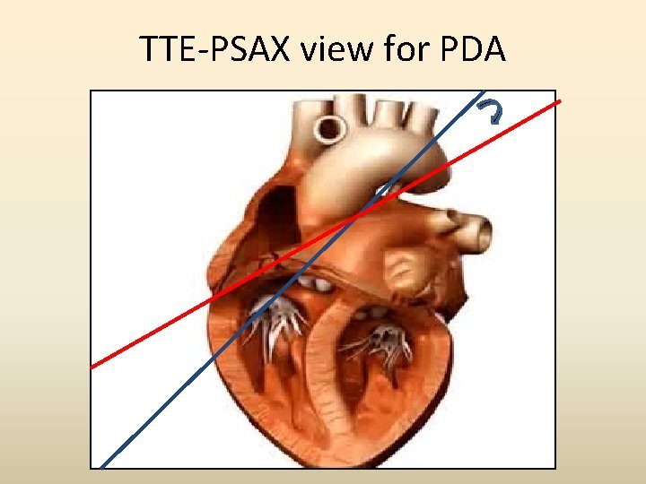 TTE-PSAX view for PDA 