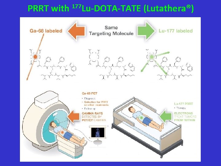 PRRT with 177 Lu-DOTA-TATE (Lutathera®) 