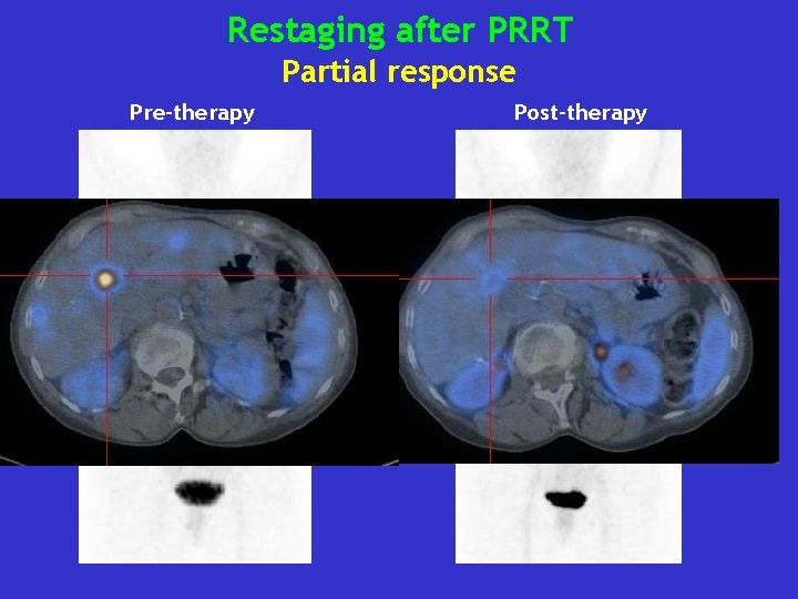 Restaging after PRRT Partial response Pre-therapy Post-therapy 
