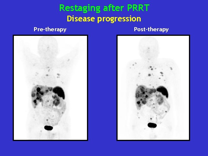 Restaging after PRRT Disease progression Pre-therapy Post-therapy 