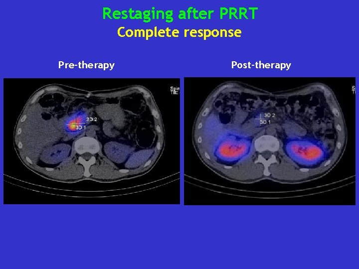 Restaging after PRRT Complete response Pre-therapy Post-therapy 