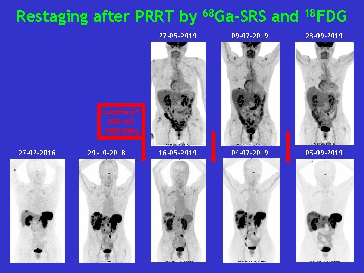 Restaging after PRRT by 68 Ga-SRS and 18 FDG 27 -05 -2019 09 -07