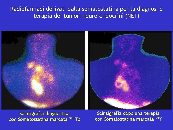 Radiofarmaci derivati dalla somatostatina per la diagnosi e terapia dei tumori neuro-endocrini (NET) Scintigrafia
