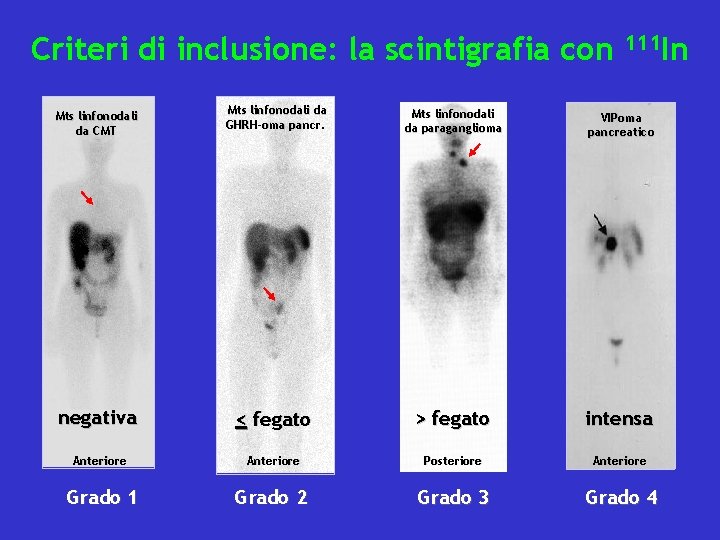 Criteri di inclusione: la scintigrafia con 111 In Mts linfonodali da CMT Mts linfonodali