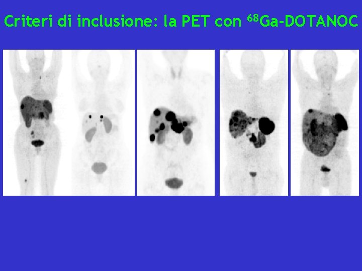 Criteri di inclusione: la PET con 68 Ga-DOTANOC 