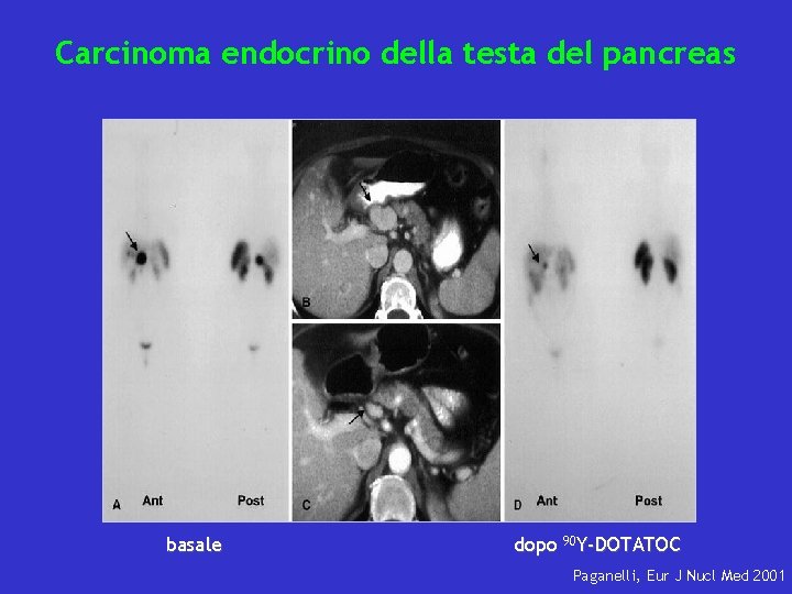 Carcinoma endocrino della testa del pancreas basale dopo 90 Y-DOTATOC Paganelli, Eur J Nucl