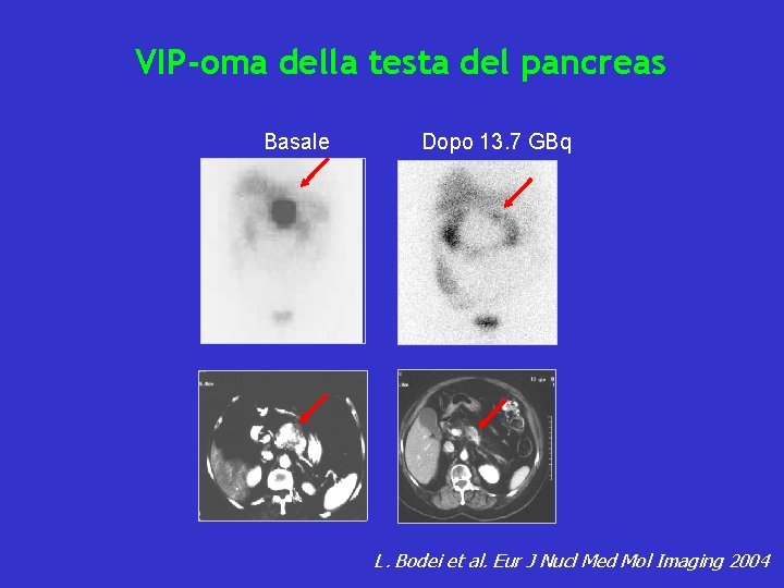 VIP-oma della testa del pancreas Basale Dopo 13. 7 GBq L. Bodei et al.