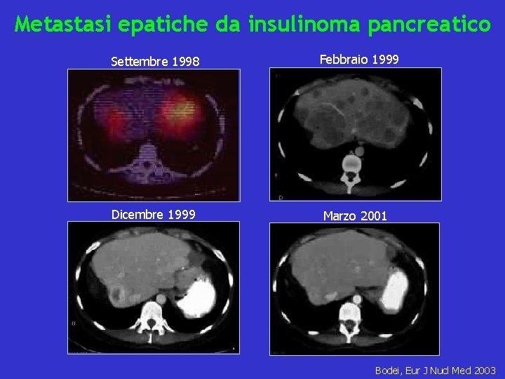 Metastasi epatiche da insulinoma pancreatico Settembre 1998 Febbraio 1999 Dicembre 1999 Marzo 2001 Bodei,