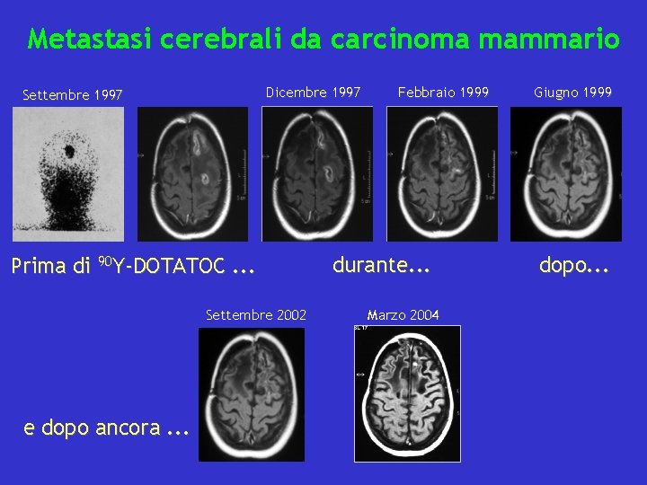 Metastasi cerebrali da carcinoma mammario Dicembre 1997 Settembre 1997 Prima di 90 Y-DOTATOC. .