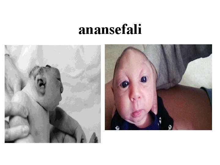 anansefali 