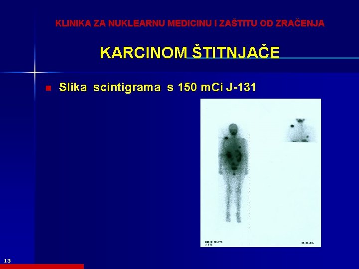 KLINIKA ZA NUKLEARNU MEDICINU I ZAŠTITU OD ZRAČENJA KARCINOM ŠTITNJAČE n 13 Slika scintigrama