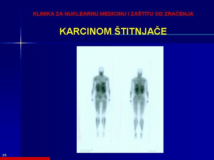 KLINIKA ZA NUKLEARNU MEDICINU I ZAŠTITU OD ZRAČENJA KARCINOM ŠTITNJAČE 15 