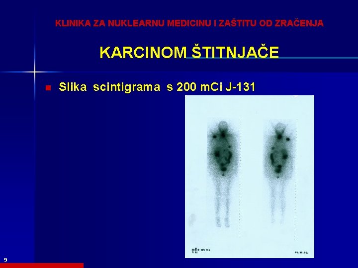 KLINIKA ZA NUKLEARNU MEDICINU I ZAŠTITU OD ZRAČENJA KARCINOM ŠTITNJAČE n 9 Slika scintigrama