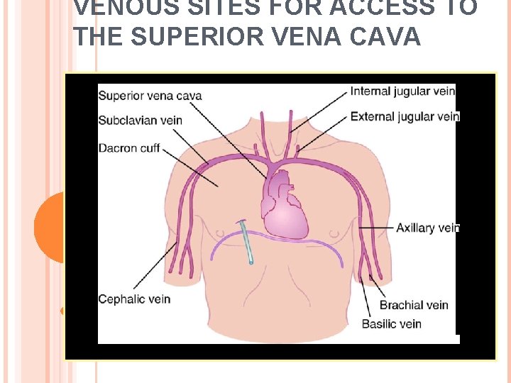 VENOUS SITES FOR ACCESS TO THE SUPERIOR VENA CAVA 