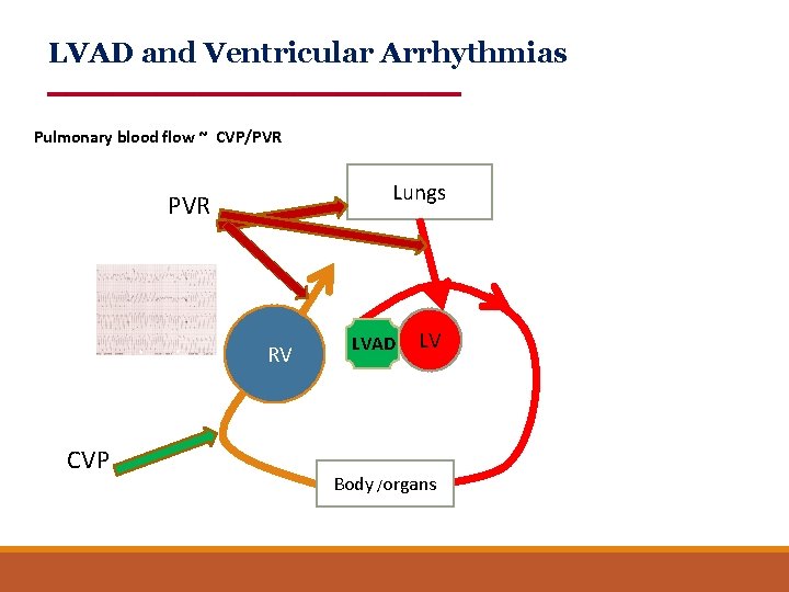 LVAD and Ventricular Arrhythmias Pulmonary blood flow ~ CVP/PVR Lungs PVR RV CVP LVAD