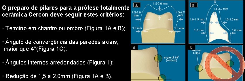 O preparo de pilares para a prótese totalmente cerâmica Cercon deve seguir estes critérios: