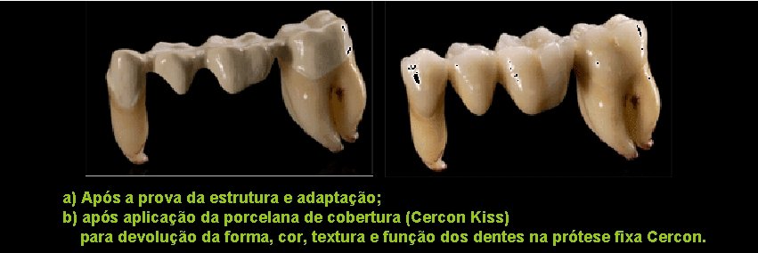 a) Após a prova da estrutura e adaptação; b) após aplicação da porcelana de