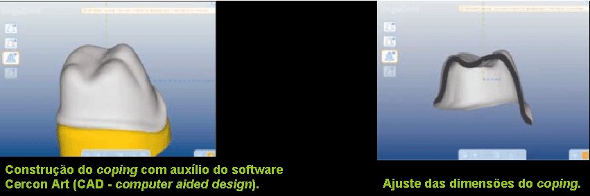 Construção do coping com auxílio do software Cercon Art (CAD - computer aided design).