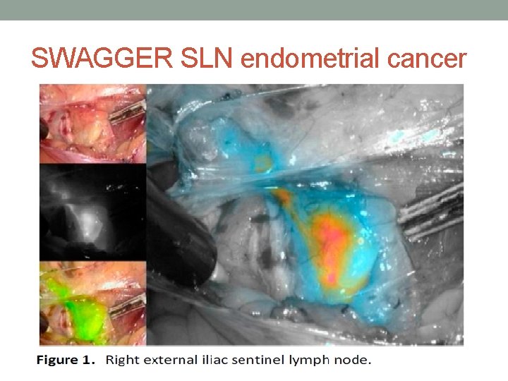 SWAGGER SLN endometrial cancer 